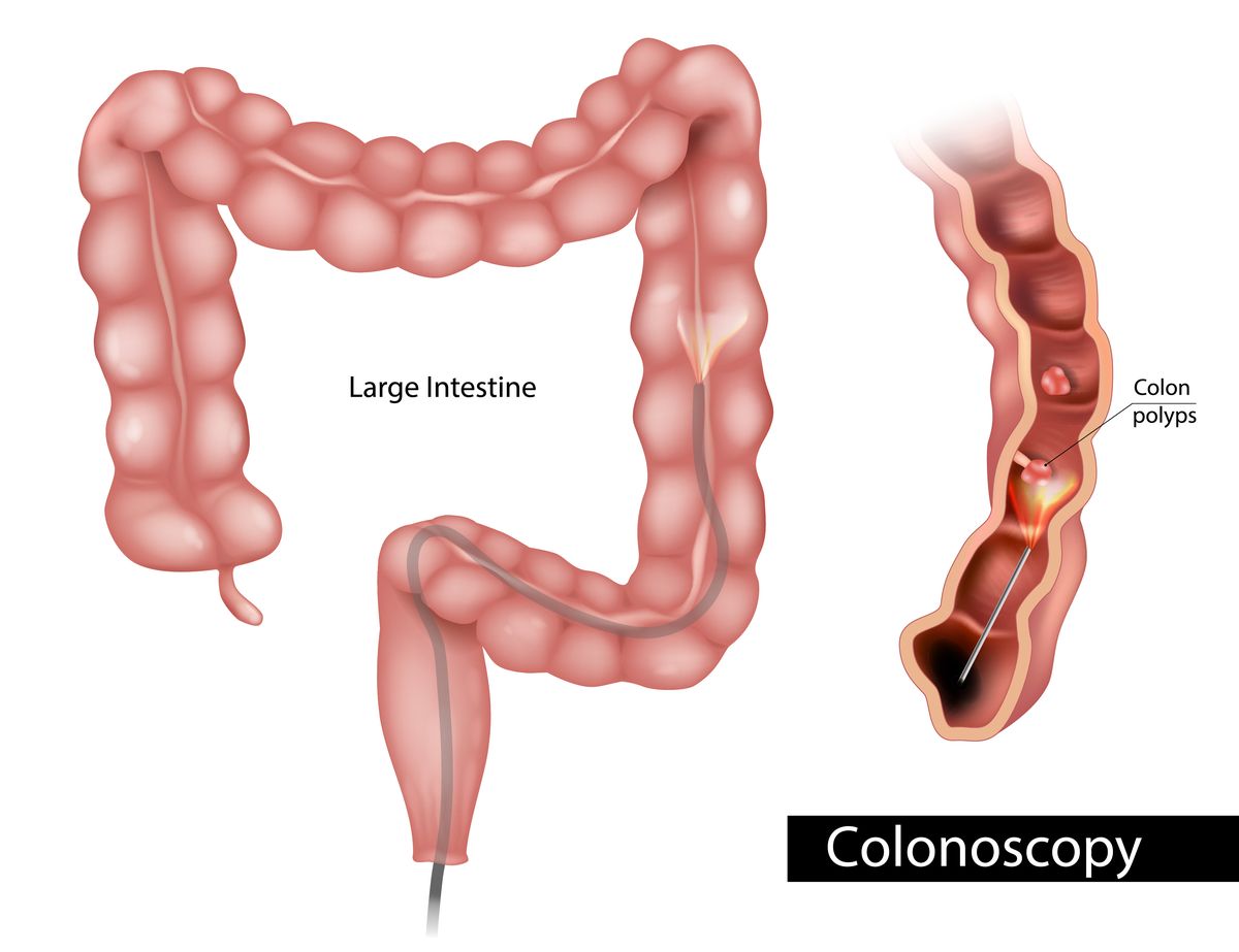 Colonoscopy showing polyps during screening