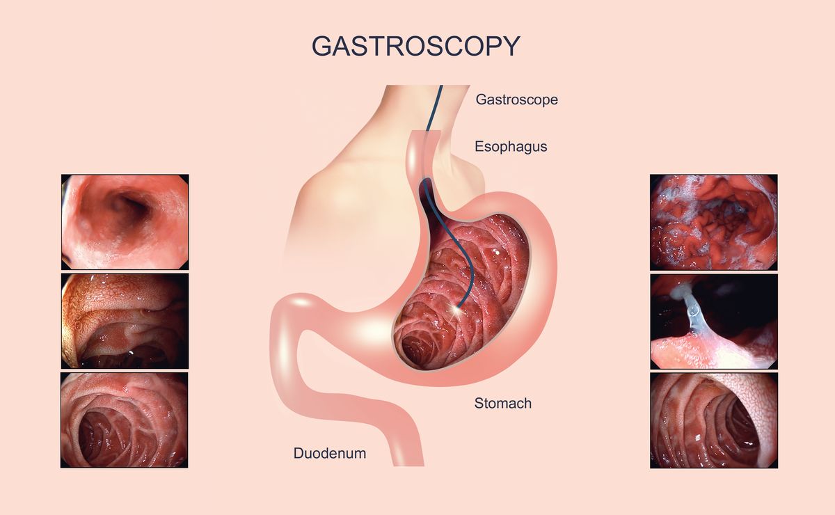 Gastroscopy procedure