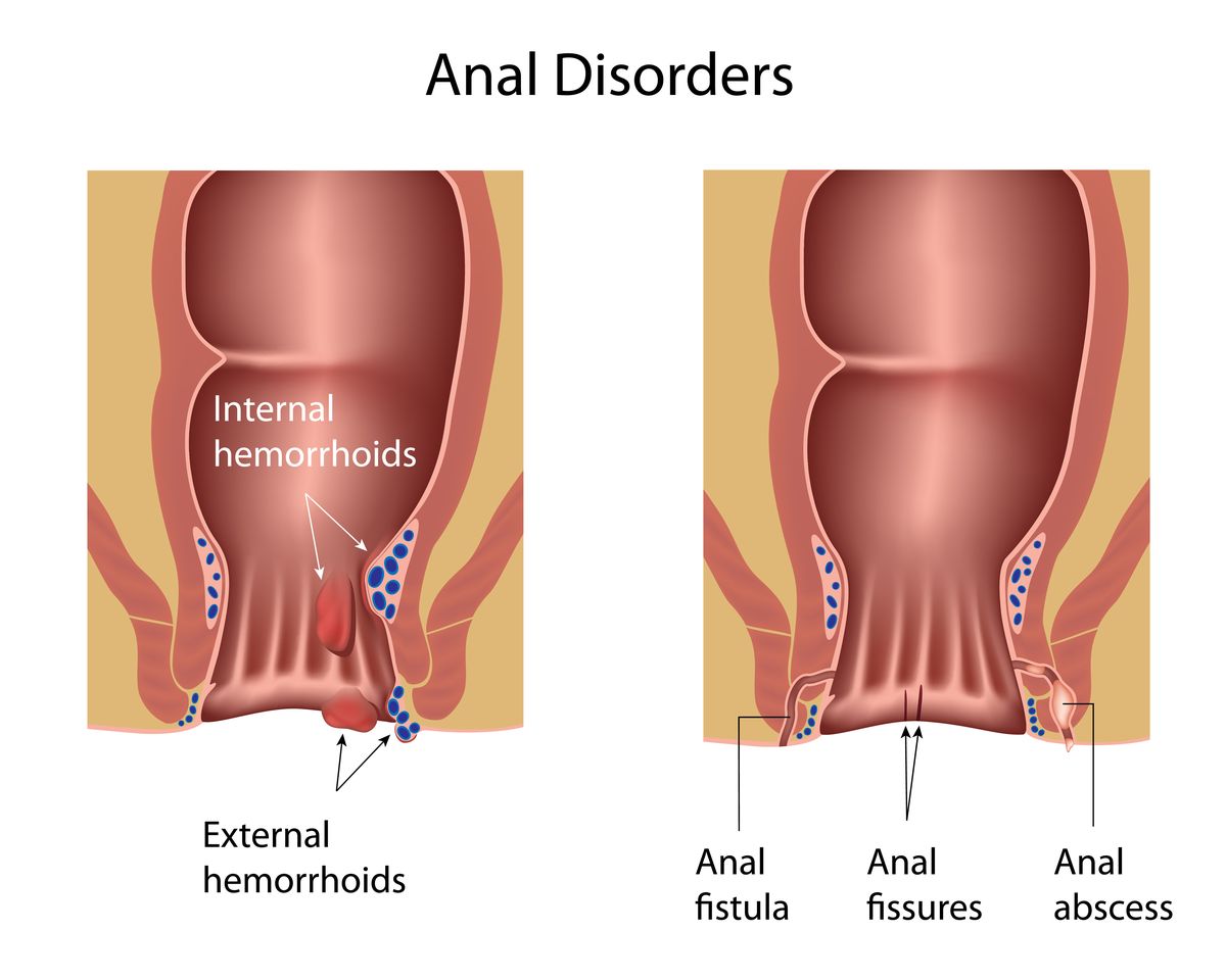 Perianal conditions