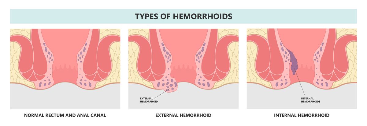 Types of haemorrhoids